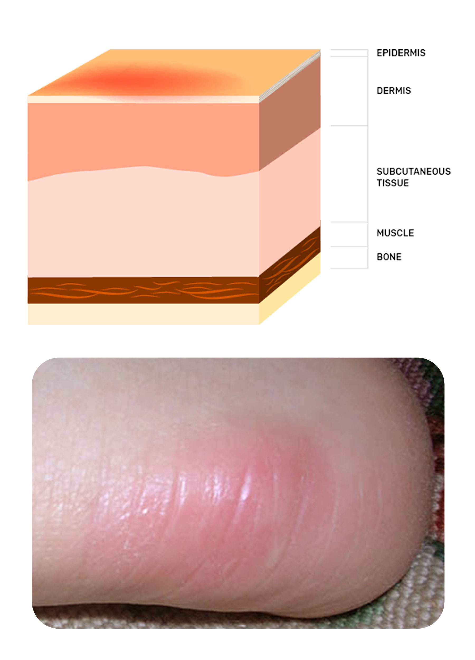 Stage 1 of a pressure injury on the heel of a foot | Image