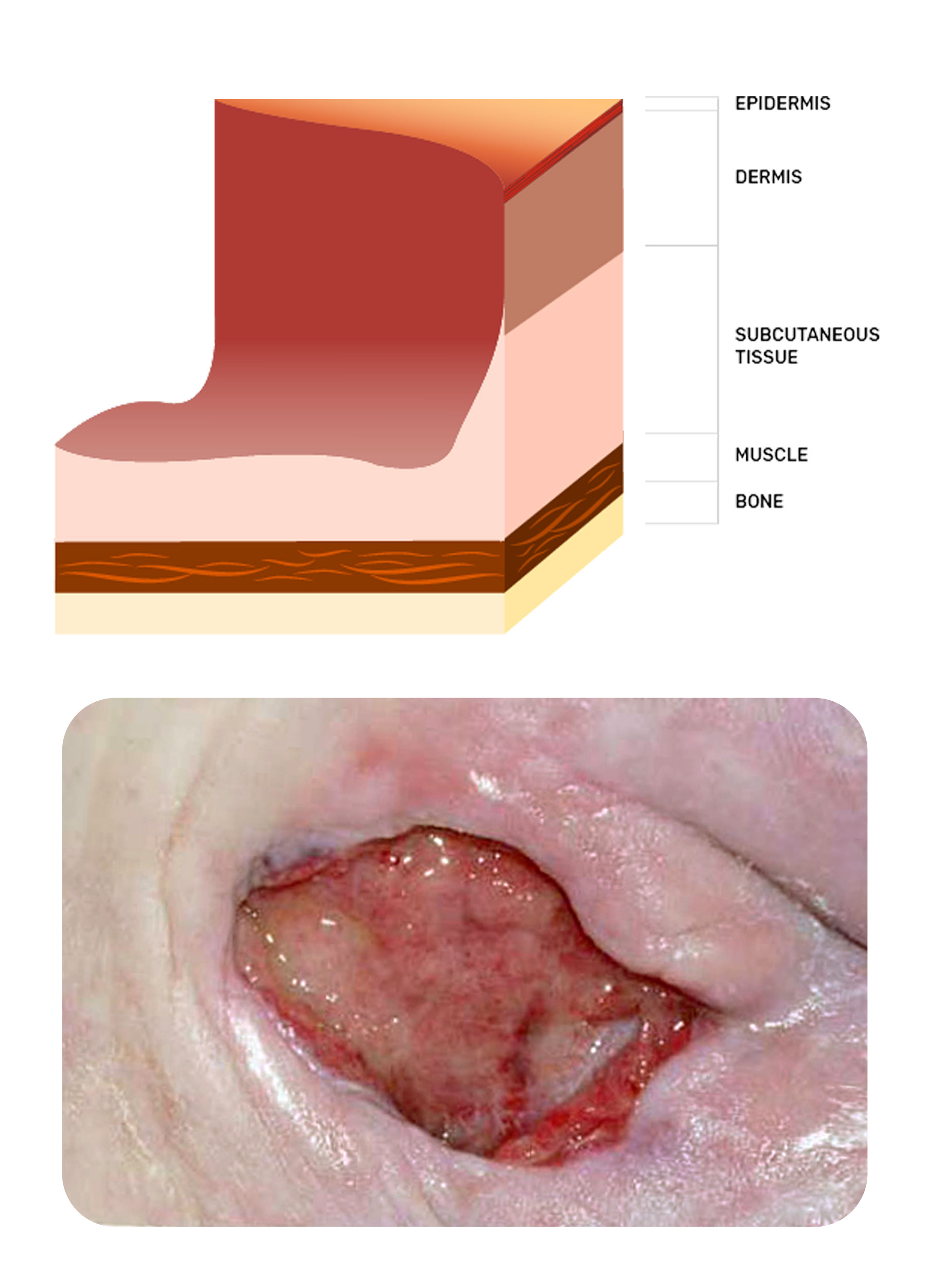 Stage 3 of a pressure injury on the heel of a foot | Image
