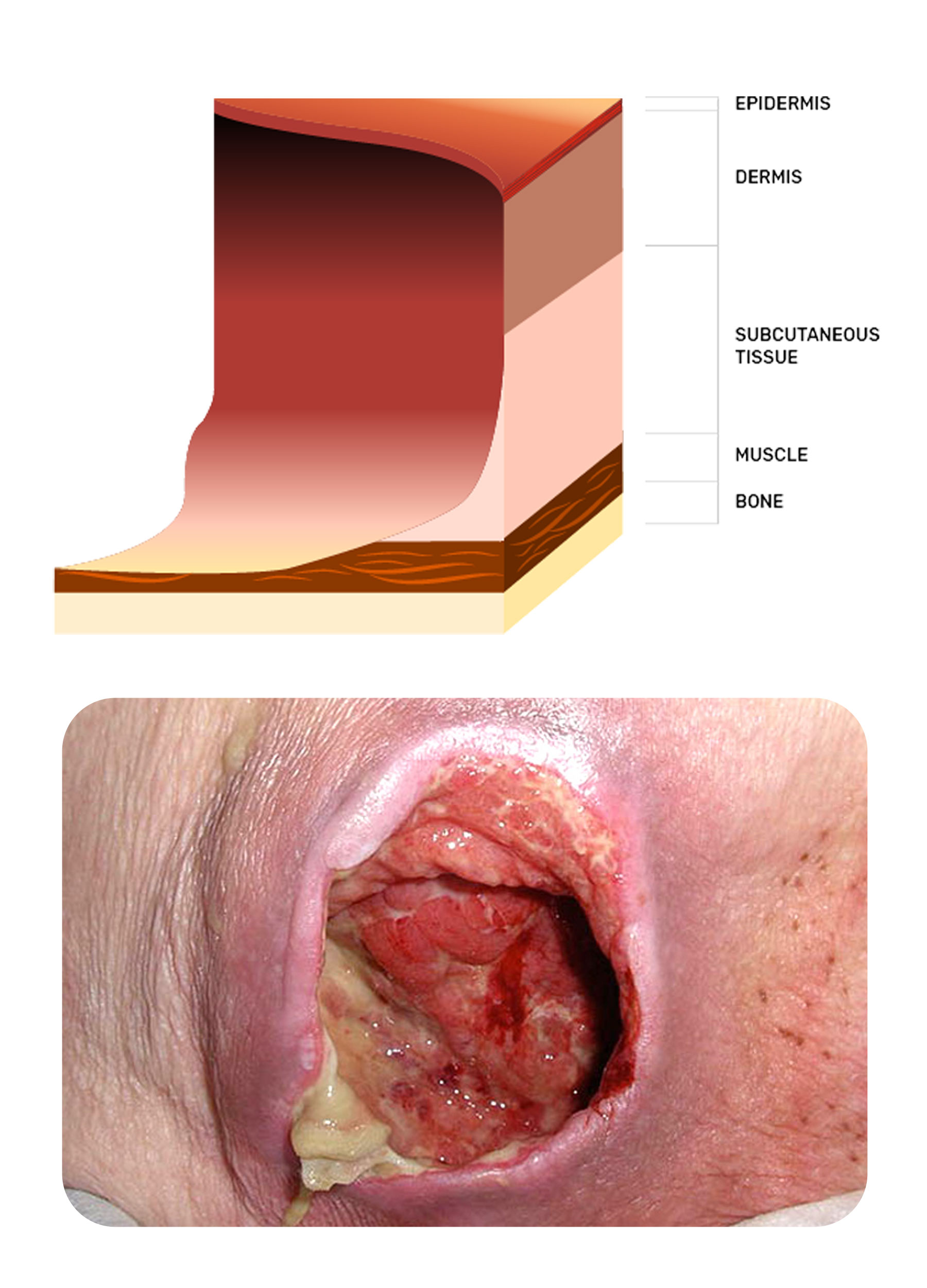 Stage 4 of a pressure injury on the heel of a foot | Image