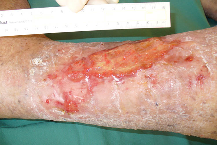 Venous leg ulcer being measured | Image